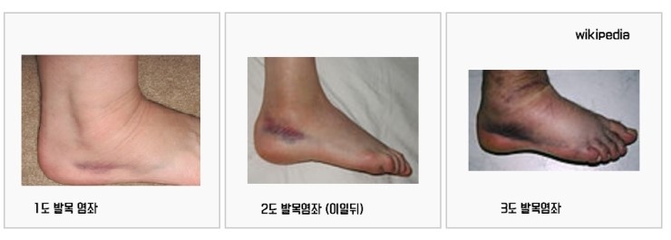 발목 인대 회복 단계 비교